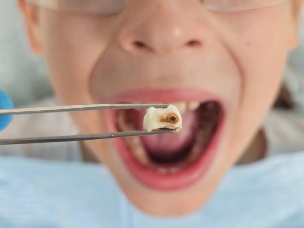 Best Emergency Treatment for Dental Infections or Abscesses in Lake Ssota, WI